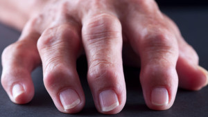 arthritis fingers